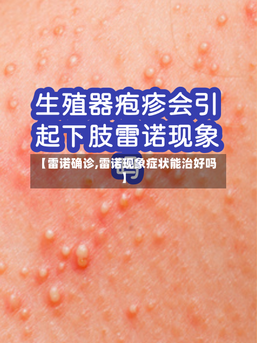 【雷诺确诊,雷诺现象症状能治好吗】-第1张图片