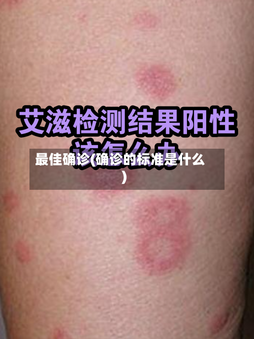 最佳确诊(确诊的标准是什么)-第1张图片