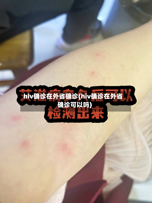 hiv确诊在外省确诊(hiv确诊在外省确诊可以吗)