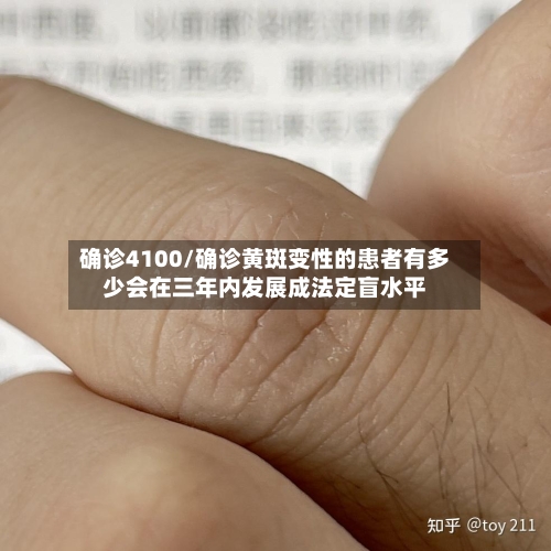 确诊4100/确诊黄斑变性的患者有多少会在三年内发展成法定盲水平