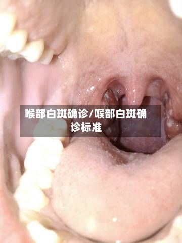 喉部白斑确诊/喉部白斑确诊标准