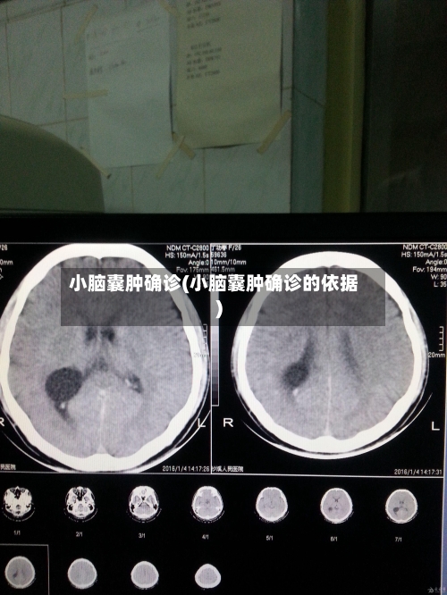 小脑囊肿确诊(小脑囊肿确诊的依据)-第2张图片