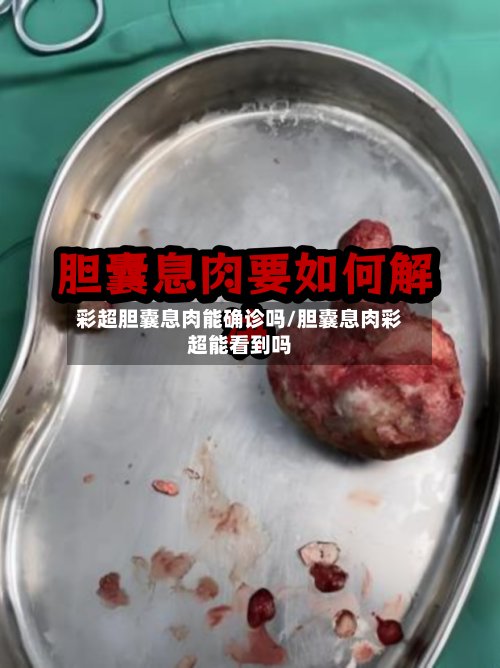 彩超胆囊息肉能确诊吗/胆囊息肉彩超能看到吗-第2张图片