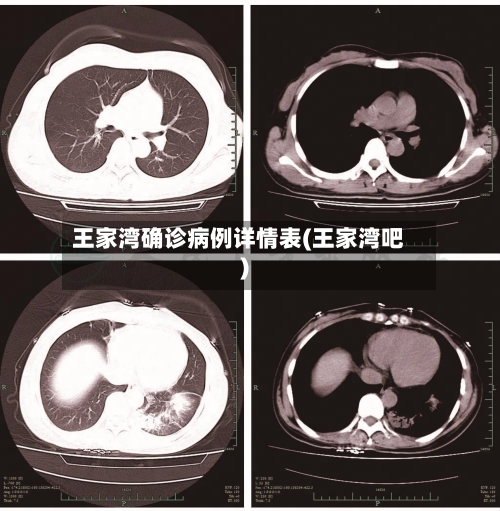 王家湾确诊病例详情表(王家湾吧)-第2张图片