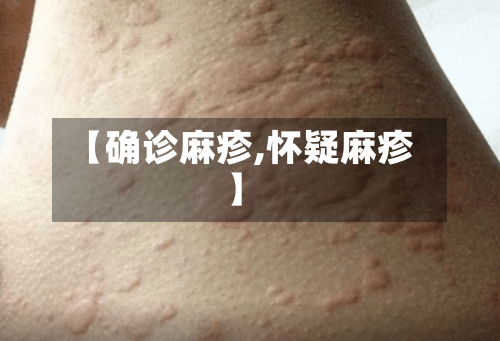 【确诊麻疹,怀疑麻疹】